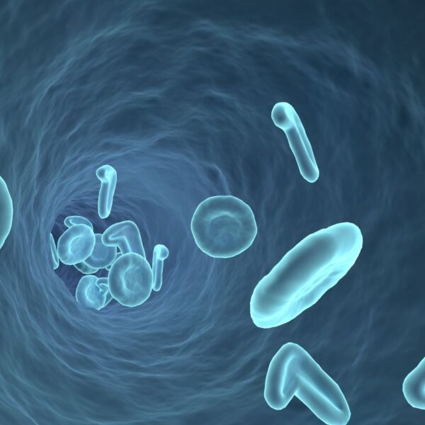 早期膵がん　９割を発見　末梢全血の遺伝子発現パターンから